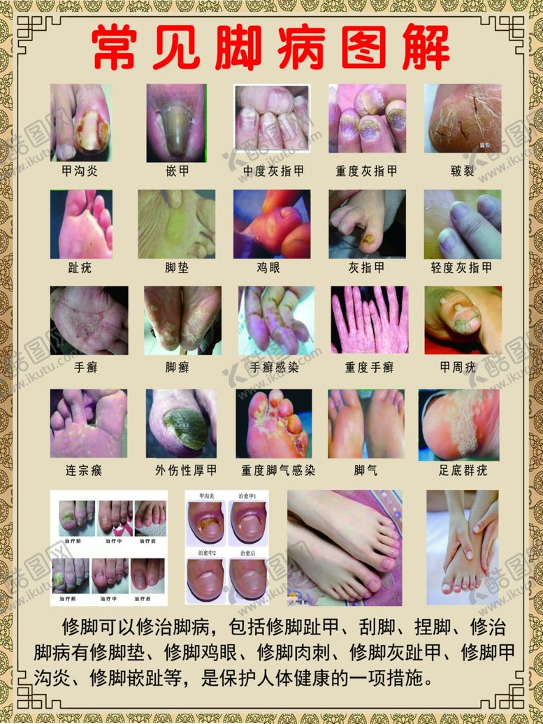 编号：80767502120844247337【酷图网】源文件下载-脚病脚气图解