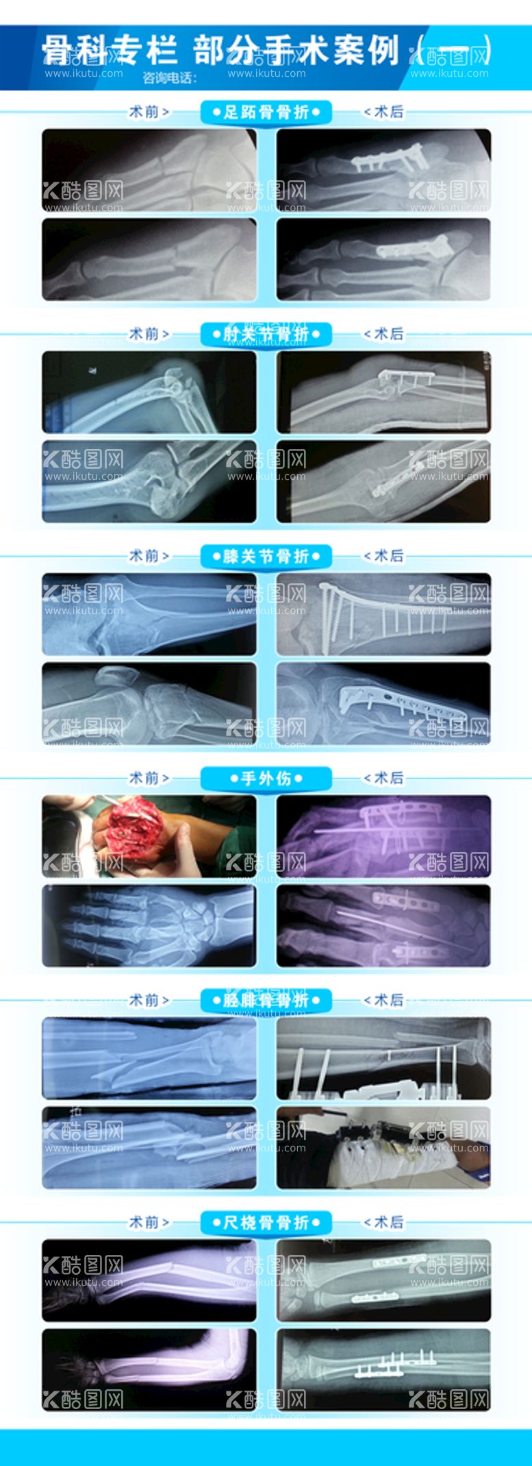 编号：52325211160516515451【酷图网】源文件下载-骨科手术案例展示