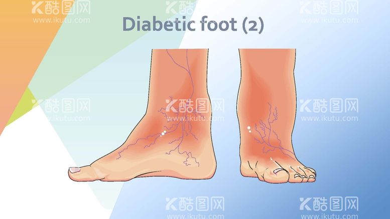 编号：48887911240251336524【酷图网】源文件下载-糖尿病足