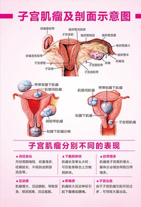 子宫肌瘤示意图子宫肌瘤表现