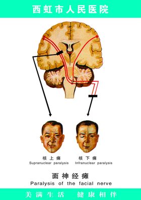 面瘫