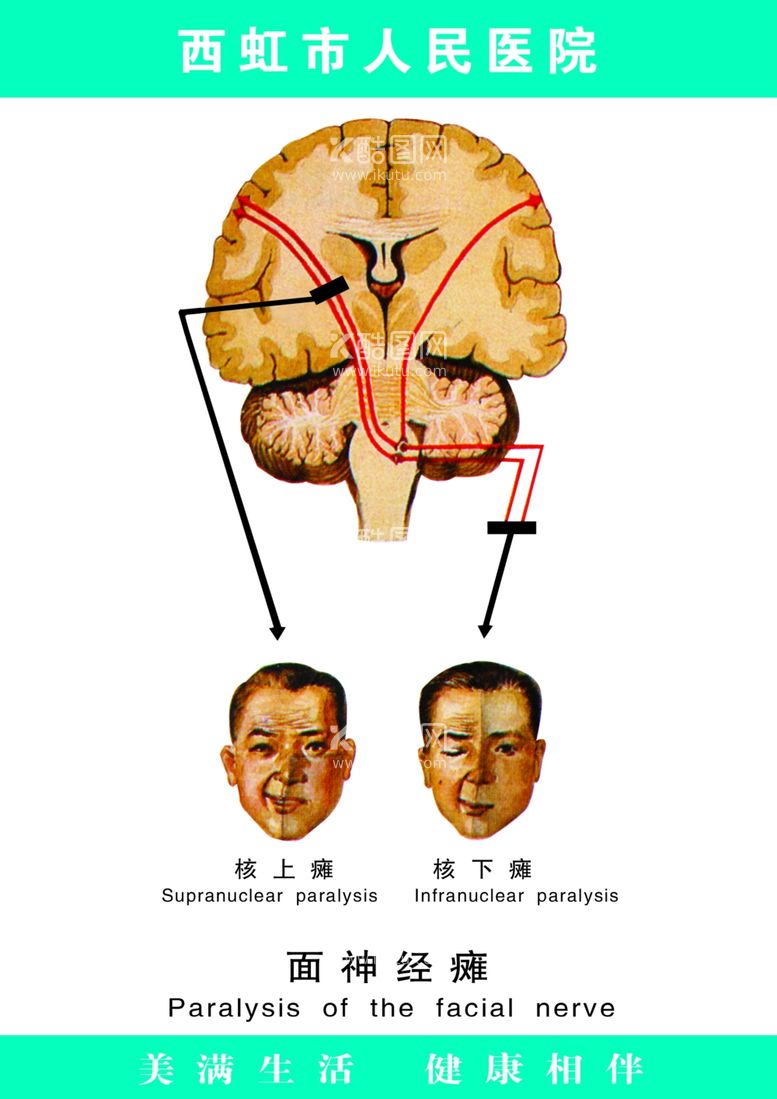 编号：71949601171314507464【酷图网】源文件下载-面瘫