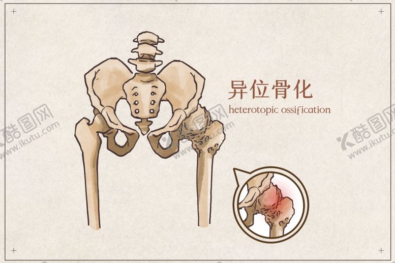 编号：32920601252120101802【酷图网】源文件下载-异位骨化