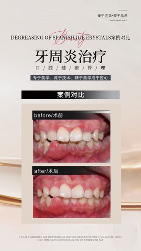 牙周炎口腔海报