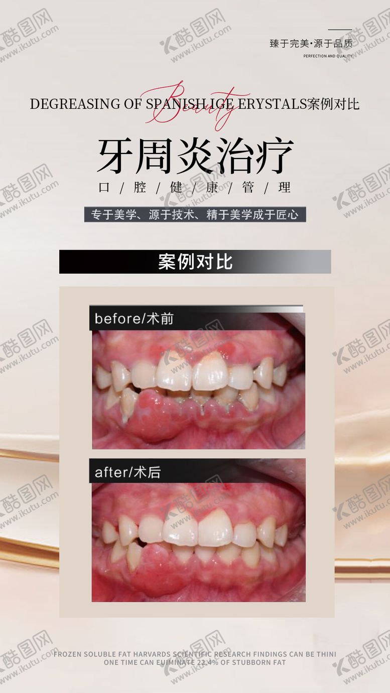 编号：72135406301444212369【酷图网】源文件下载-牙周炎治疗对比图海报