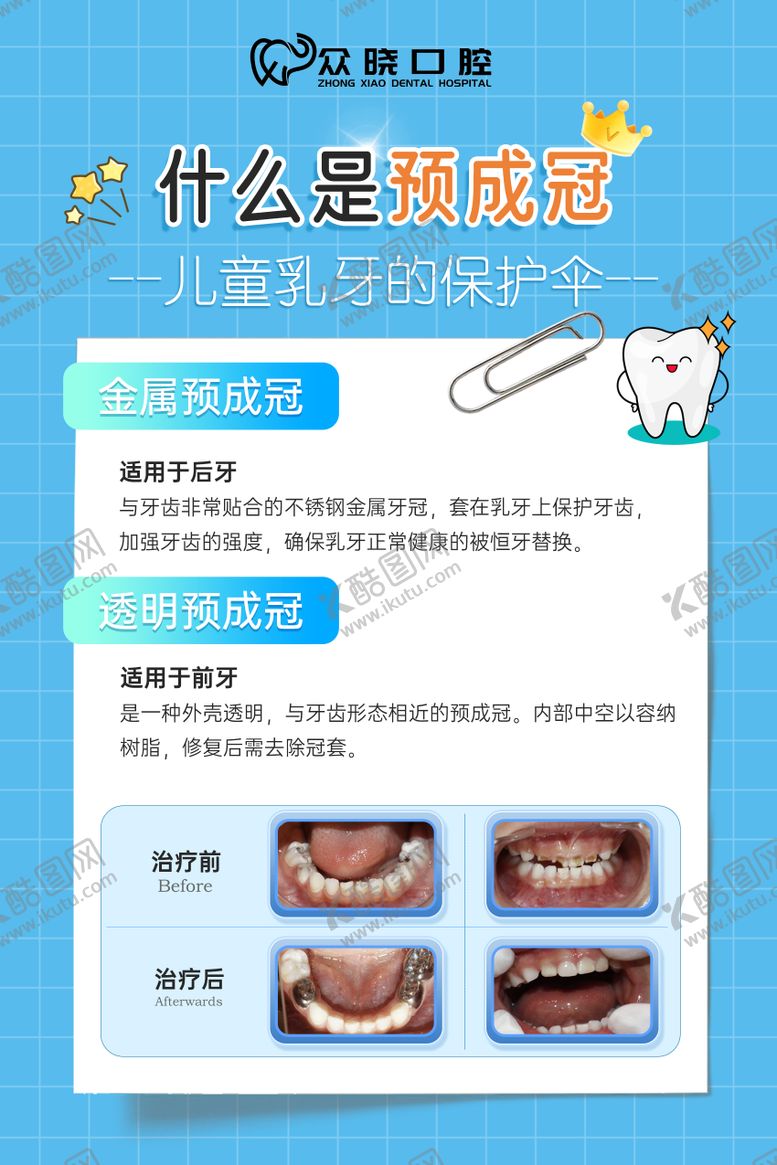 编号：76140809080423525382【酷图网】源文件下载-口腔预成冠科普
