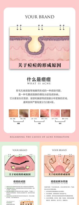 痘痘的形成原因海报