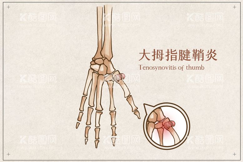 编号：92413009241231278253【酷图网】源文件下载-腱鞘炎