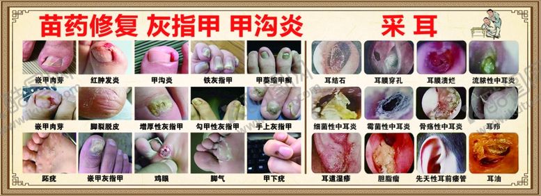 编号：36744612182138501804【酷图网】源文件下载-灰指甲耳道修脚