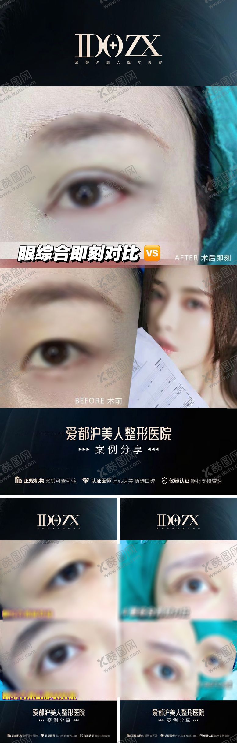 编号：23000110091625277621【酷图网】源文件下载-医美双眼皮案例