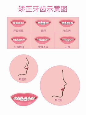 牙齿矫正示意图