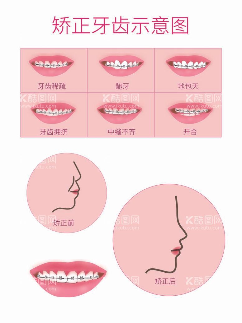 编号：11282311300135435509【酷图网】源文件下载-牙齿矫正示意图