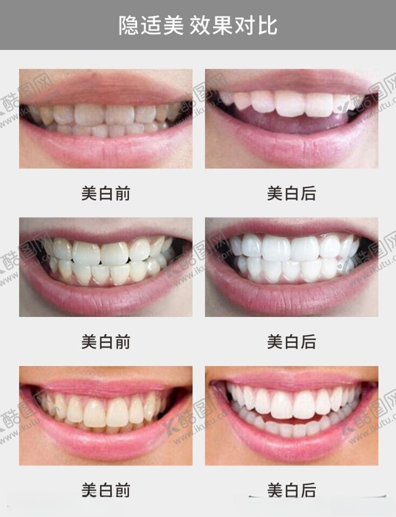 编号：43126502142251234479【酷图网】源文件下载-隐适美对比