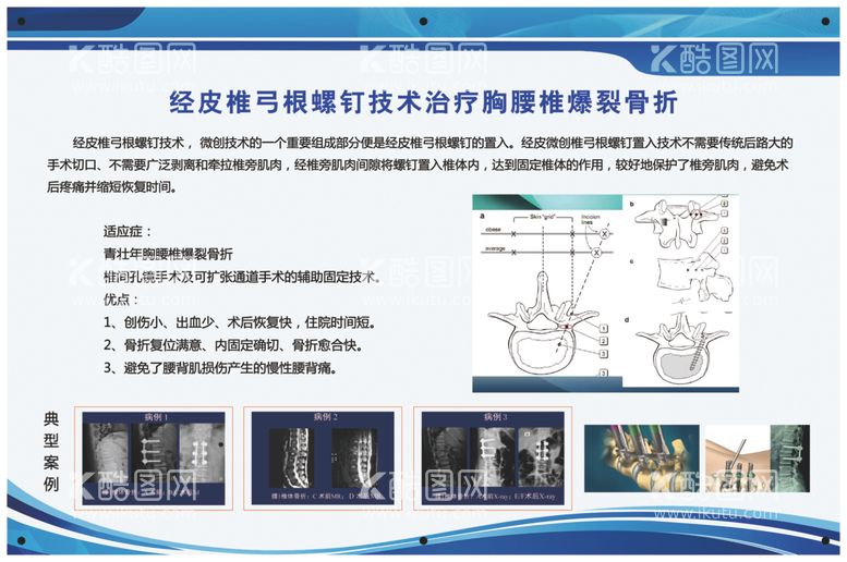 编号：29748802101442112199【酷图网】源文件下载-经皮椎弓根螺钉治疗腰胸椎骨折