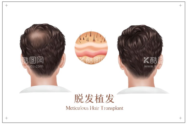 编号：62381212031330144941【酷图网】源文件下载-男性脱发植发医疗