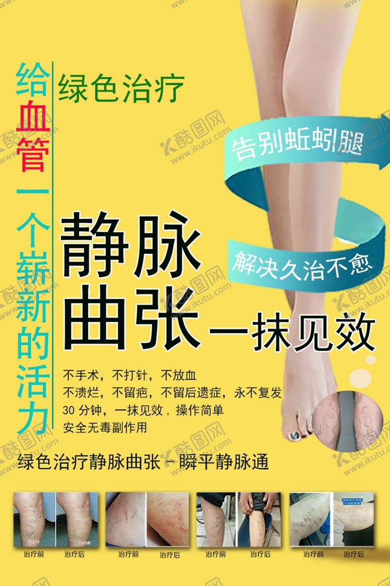 编号：42707910221258302346【酷图网】源文件下载-静脉曲张