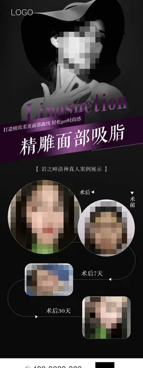 面部吸脂