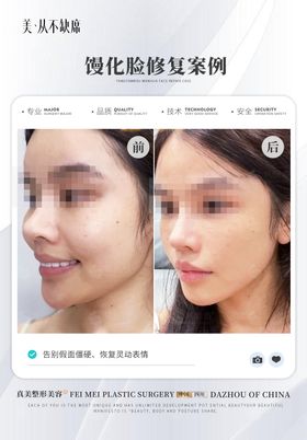 医美祛馒化修复轻薄脸案例对比海报