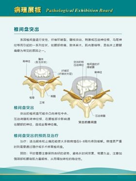 椎间盘突出