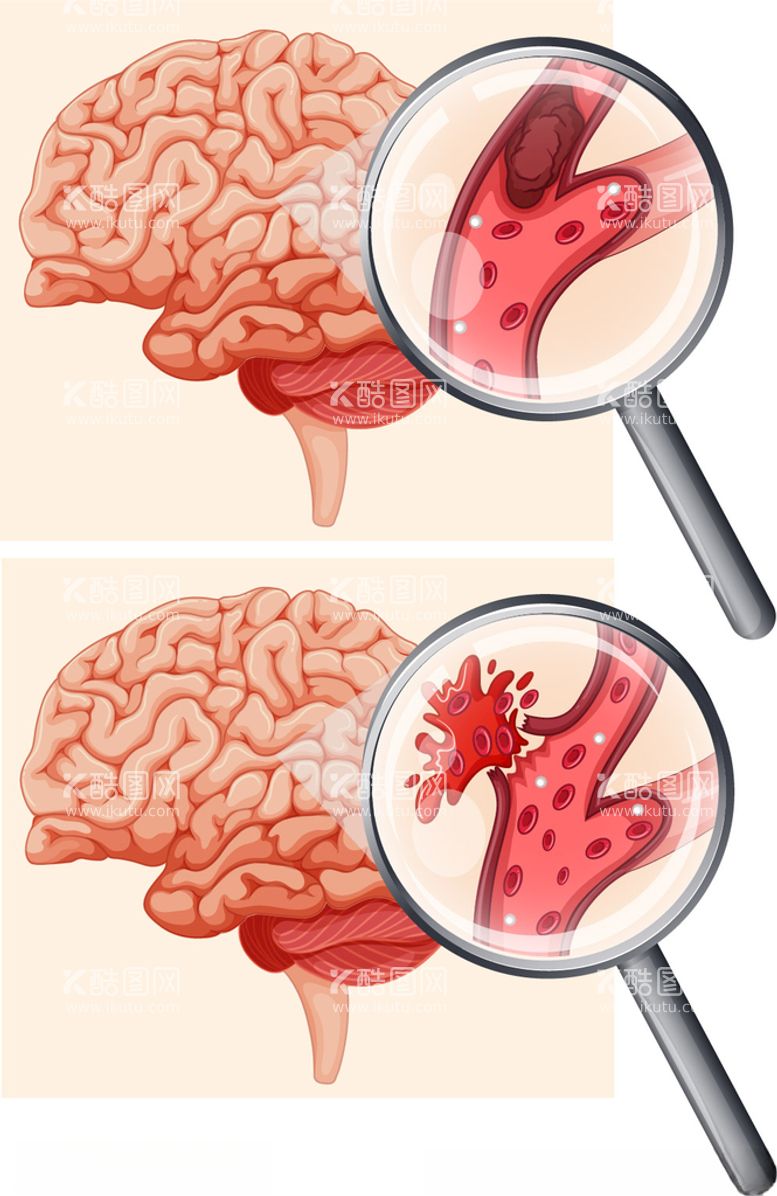 编号：16246411230357195839【酷图网】源文件下载-脑卒中