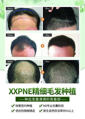 植发广告