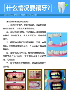 镶牙海报