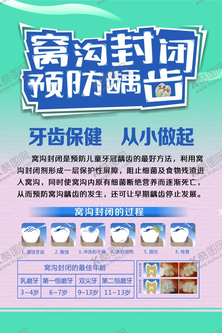 编号：14846710262341176608【酷图网】源文件下载-窝沟封闭