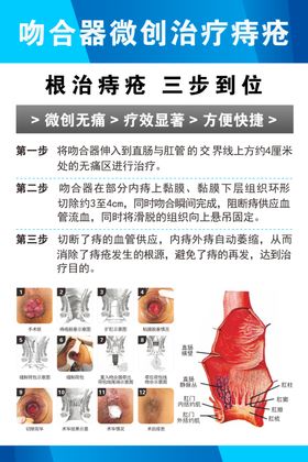 吻合器微创治疗痔疮