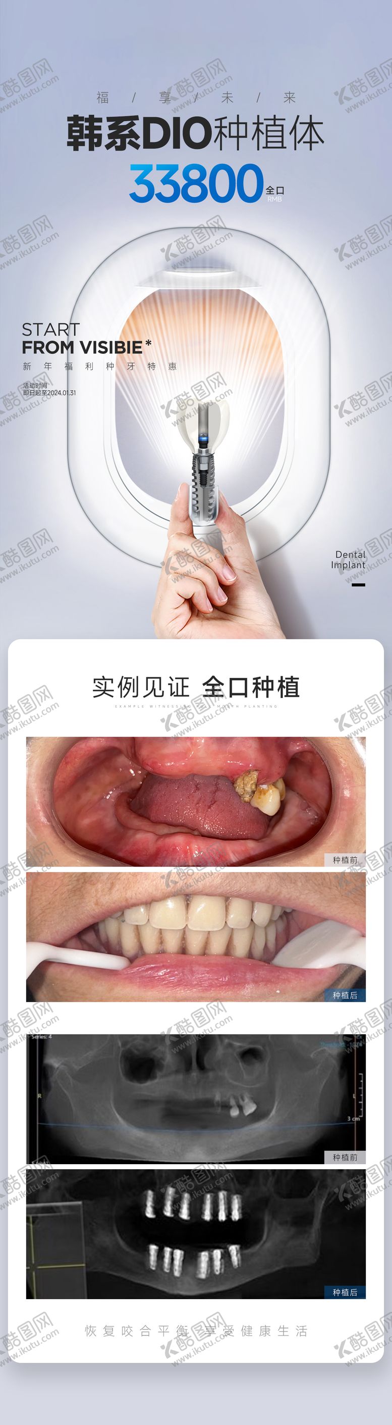 编号：46016909221718304967【酷图网】源文件下载-种植牙案例对比图