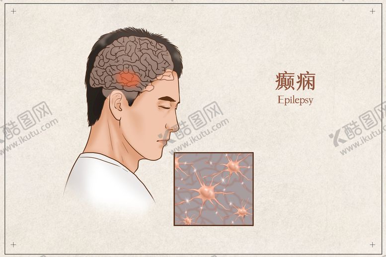 编号：56394809241245549271【酷图网】源文件下载-癫痫