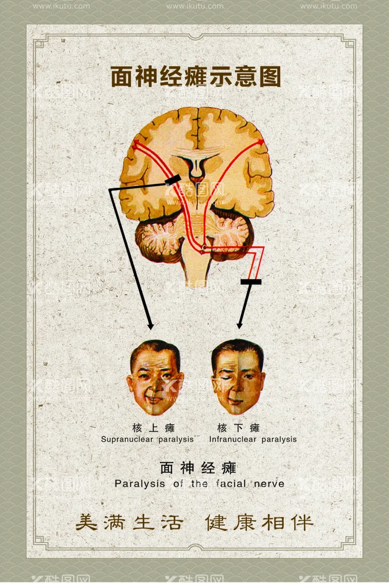 编号：36156510250807183355【酷图网】源文件下载-面神经瘫示意图