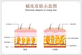 橘皮皮肤示意图