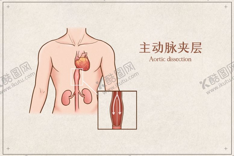 编号：12237001252129575837【酷图网】源文件下载-主动脉夹层