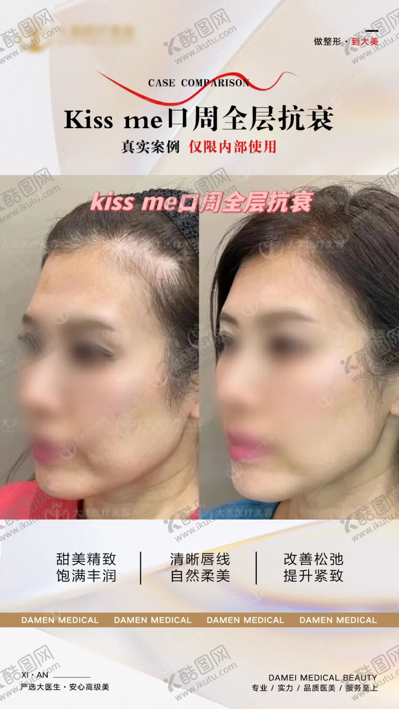 编号：17206901191529397549【酷图网】源文件下载-口周抗衰案例对比