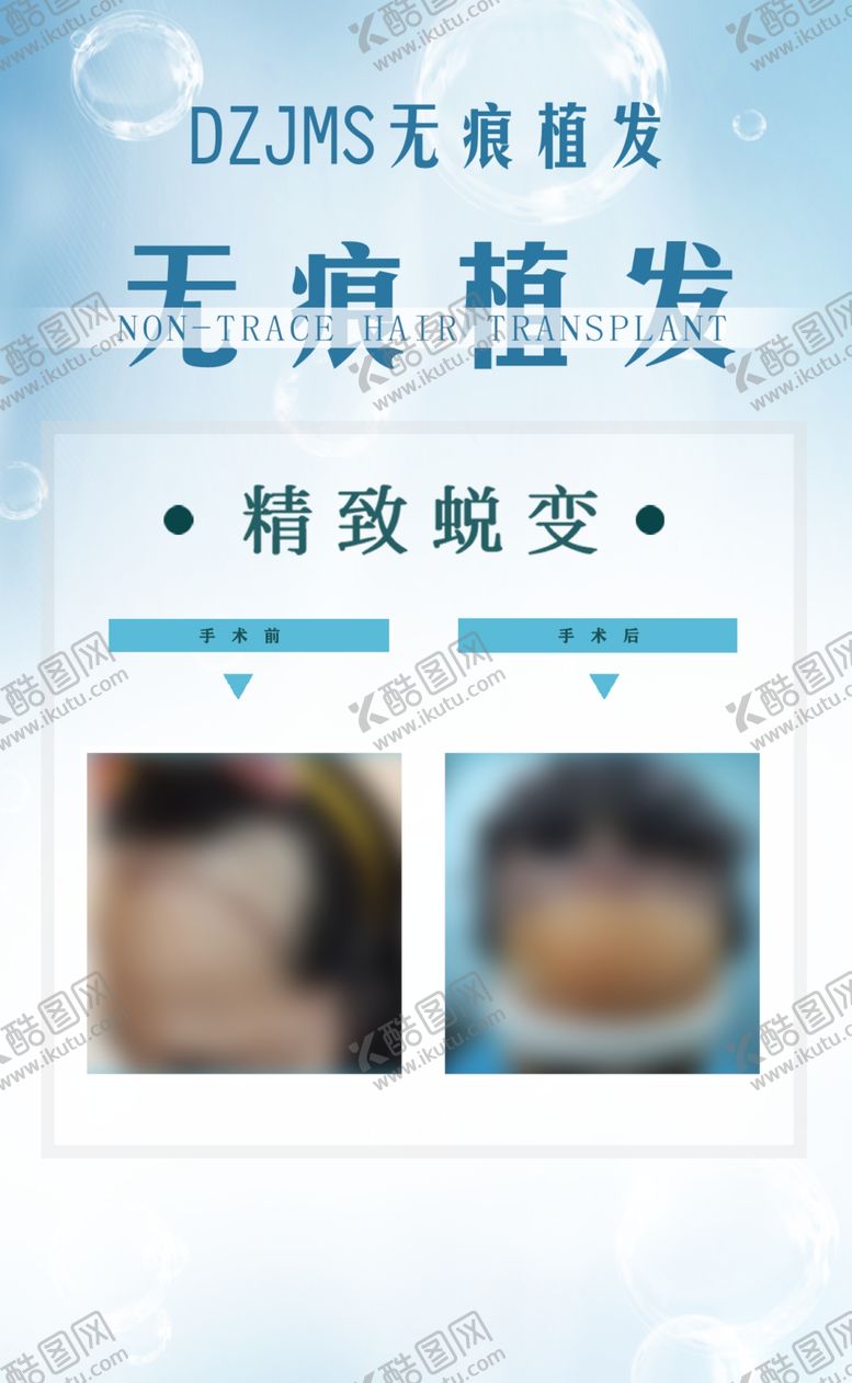 编号：67234307041312068109【酷图网】源文件下载-植发案例