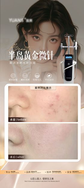 医美黄金微针祛痘案例海报