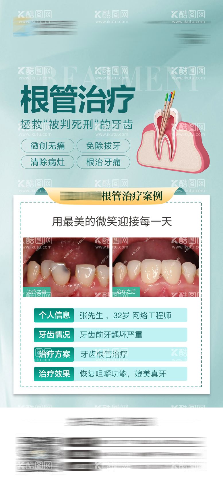 编号：34958512030633557972【酷图网】源文件下载-医美口腔牙齿根管治疗对比海报