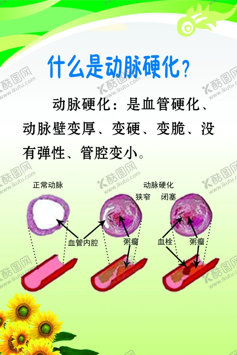编号：80951403231113419620【酷图网】源文件下载-什么是动脉硬化