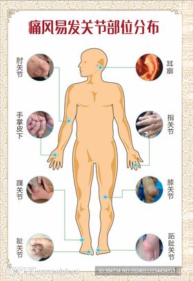 痛风易发关节部位分布图