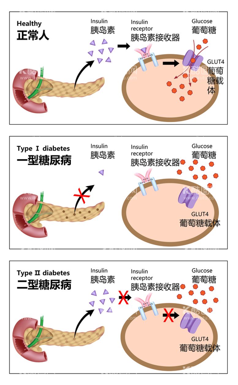 编号：84517909250713397281【酷图网】源文件下载-糖尿病类型对比