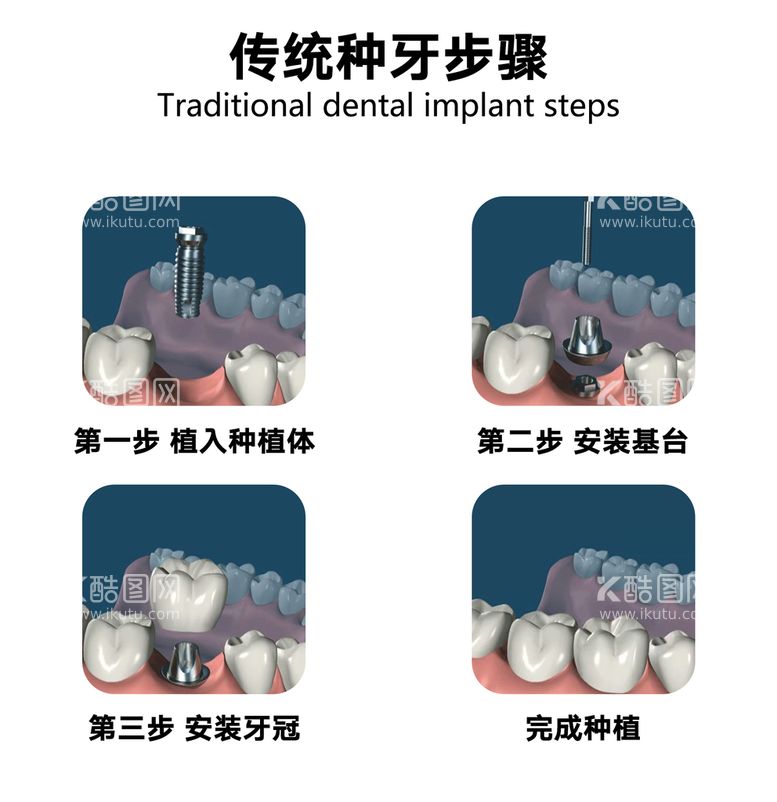 编号：35670909180311490291【酷图网】源文件下载-种植牙过程