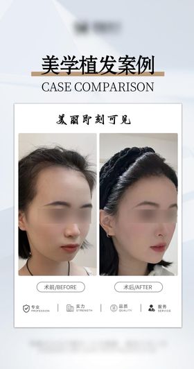 医美美学植发案例海报