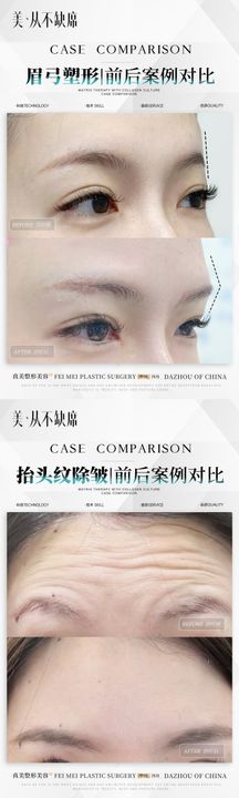 抬头纹除皱眉弓案例对比医美海报