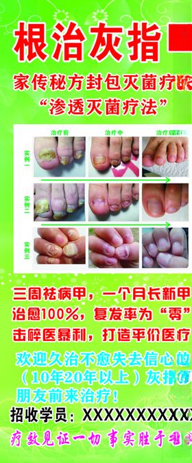 灰指甲X展架