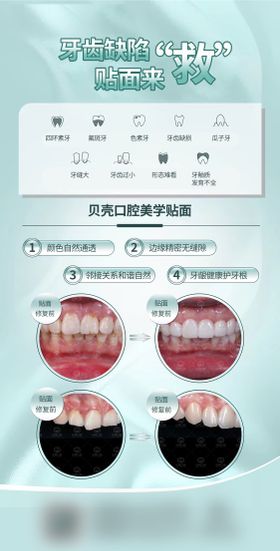 牙齿贴面案例海报