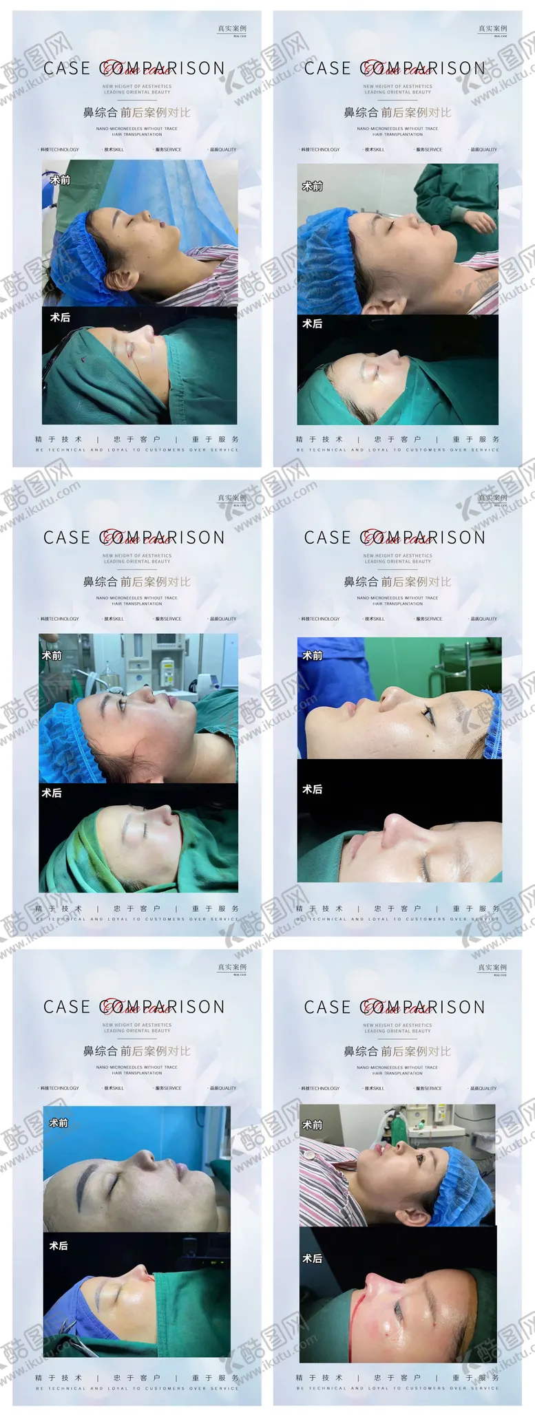医美整形案例宣传系列海报鼻综合对比眼综合