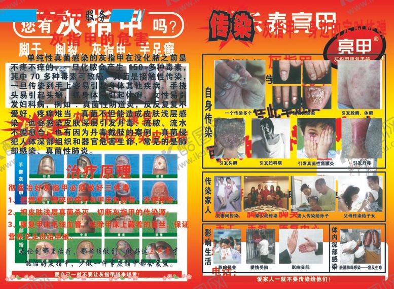 编号：24404012020150073504【酷图网】源文件下载-亮甲灰指甲宣传单