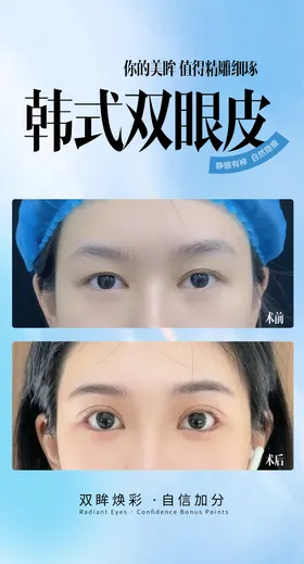 韩式双眼皮