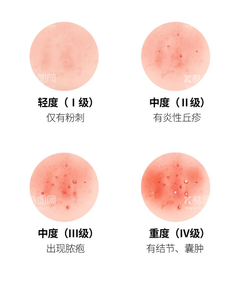 编号：33445711262227069881【酷图网】源文件下载-痤疮等级