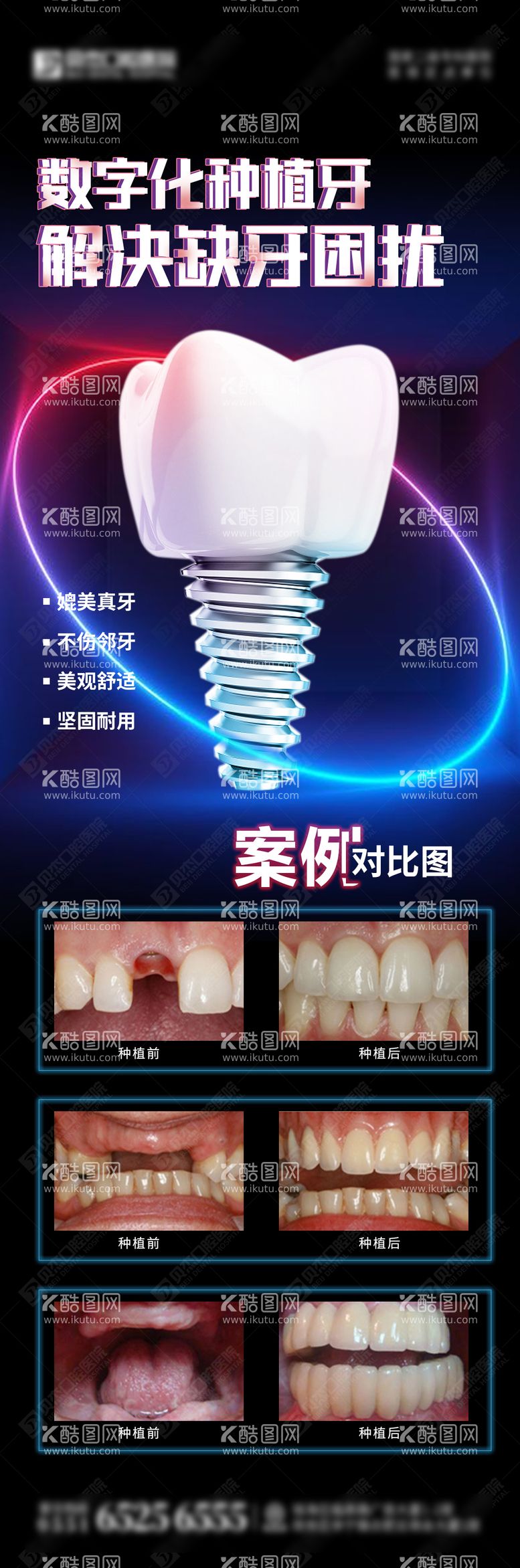 编号：10805211160529217120【酷图网】源文件下载-数字化种植牙案例